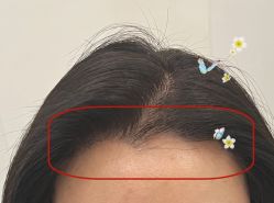 -大麦微针植发全国连锁