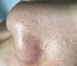 点击看大图 -荟草堂专业痘肌皮肤管理