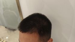 -碧莲盛·不剃发植发