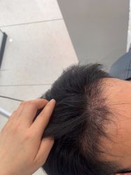 -大麦微针植发丨全国连锁