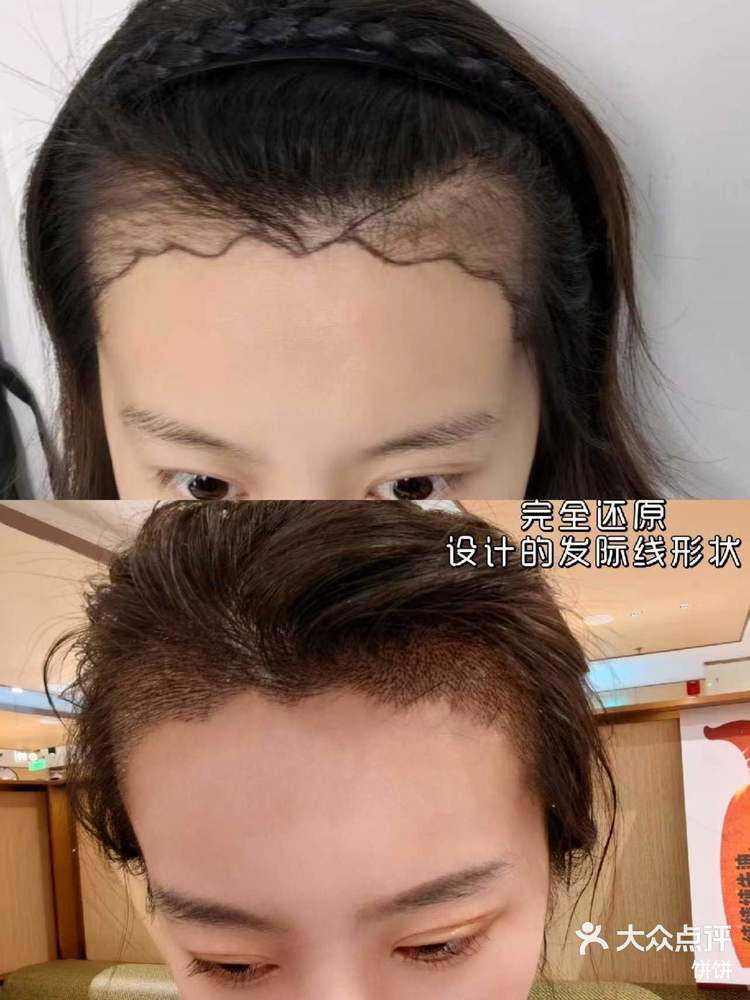 2008年植发(植发几年后的人现在怎么样了)