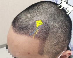 -大麦微针植发全国连锁