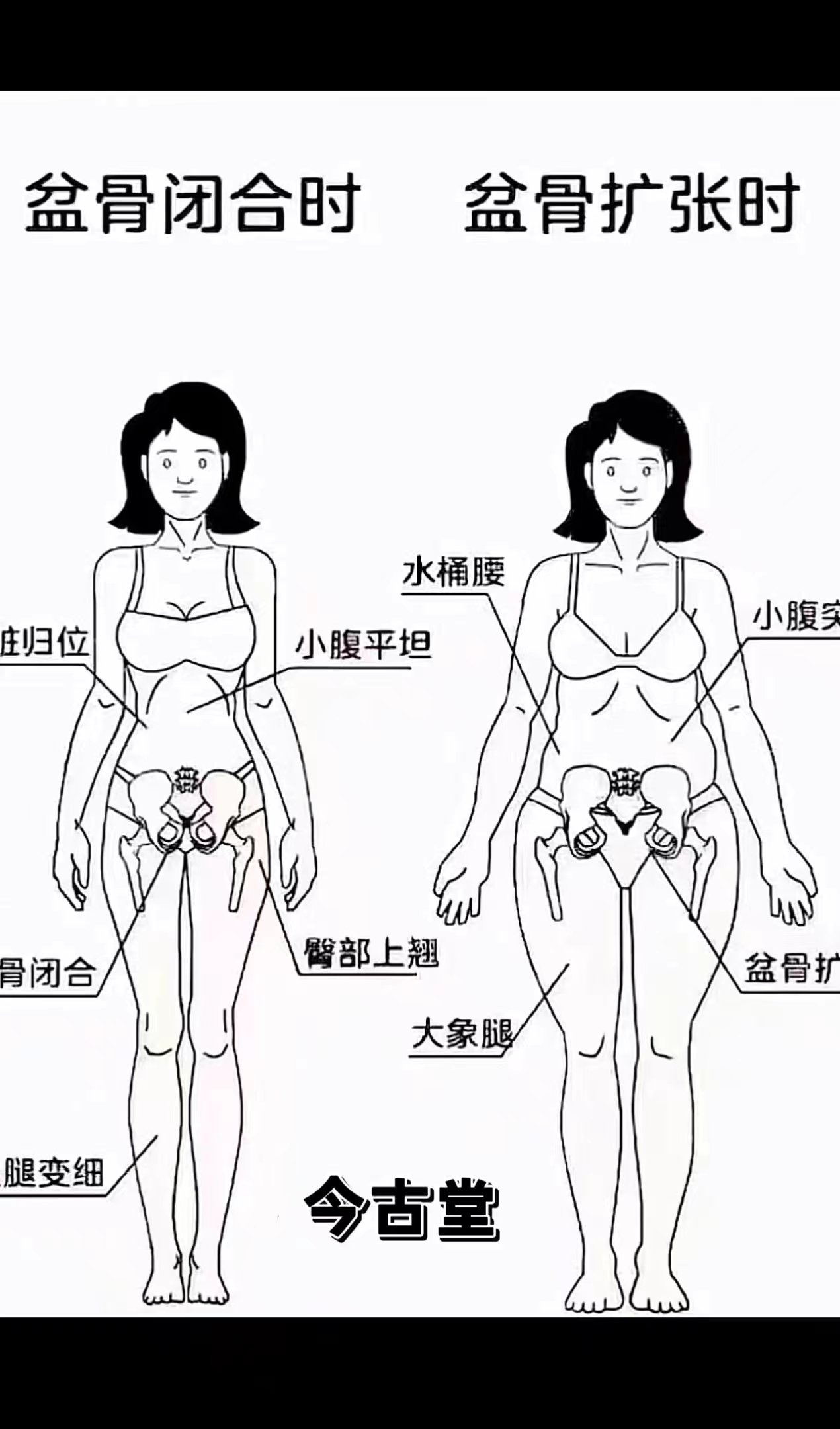 盆骨闭合图解图片