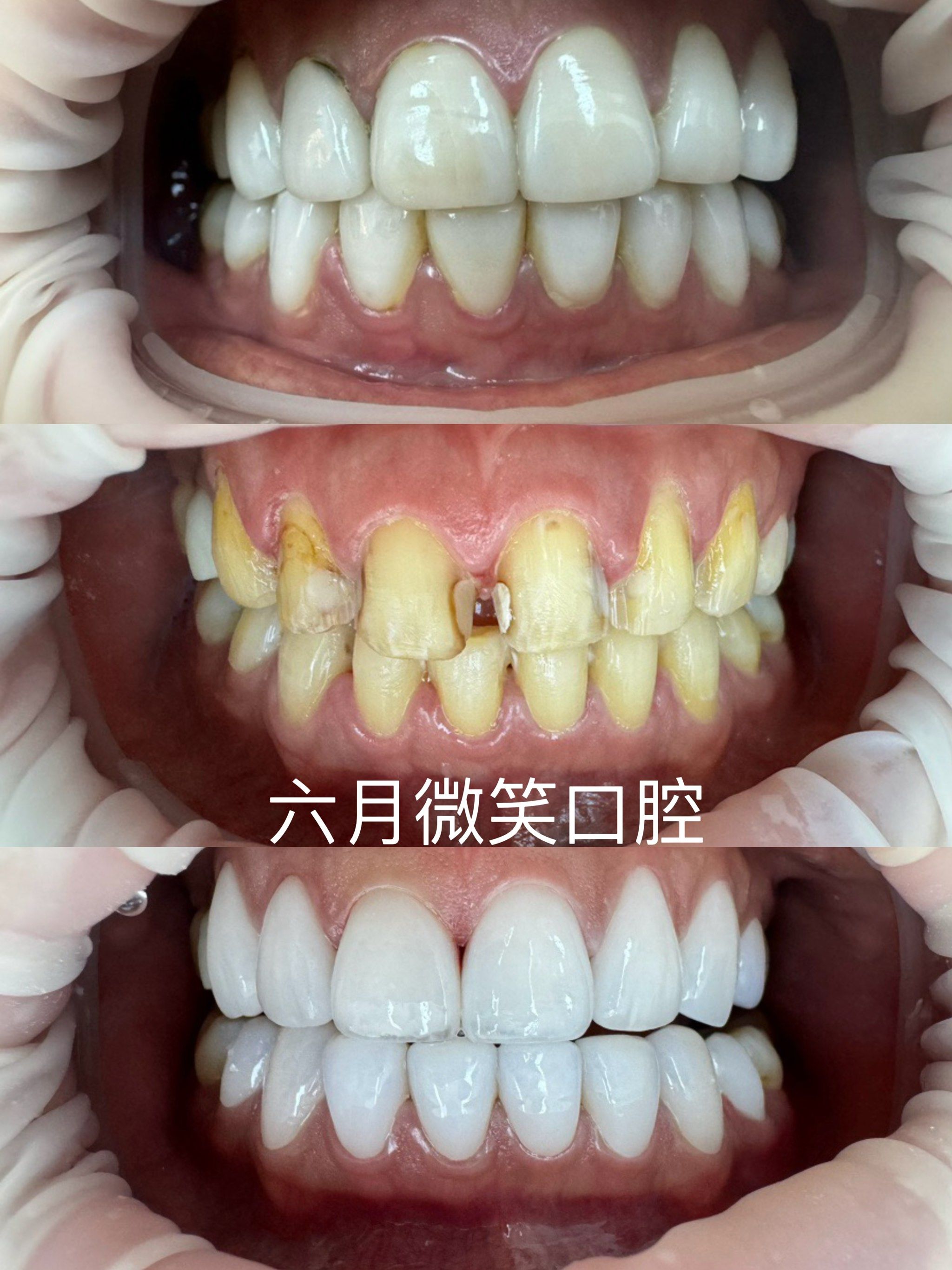 亮白牙齿自然闪耀