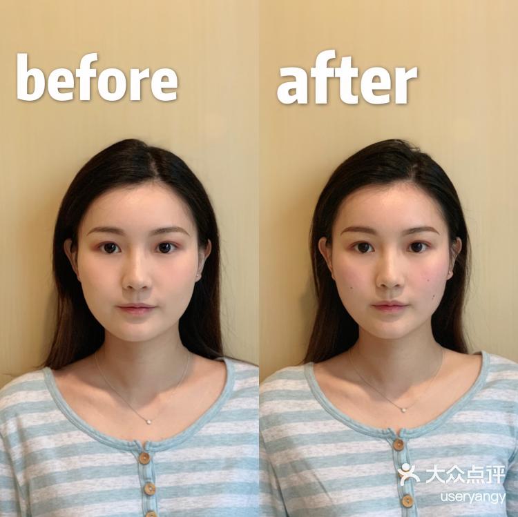 Face 日本小颜矫正美容整骨サロン 福田店 作为一个天生的包子脸一直很想瘦脸 但是打 大众点评移动版