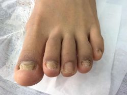 -德哥灰指甲脚气甲沟炎跖疣护理