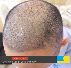 -大麦微针植发丨全国连锁