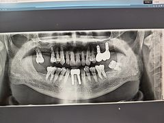 -上海仁爱医院口腔科 · 种植