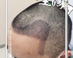 -大麦微针植发全国连锁