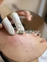 -瑶芳清颜草本祛痘