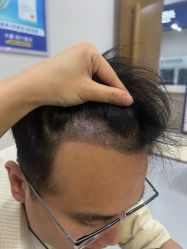 -大麦微针植发全国连锁