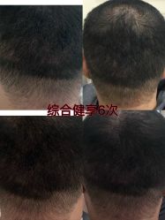 -菩叶脱发白发中心