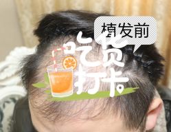 -大麦微针植发全国连锁