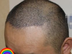 -大麦微针植发丨全国连锁