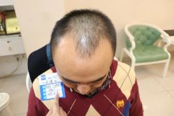 -大麦微针植发丨全国连锁