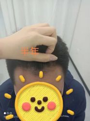 -大麦微针植发全国连锁