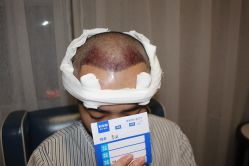 -大麦微针植发丨全国连锁