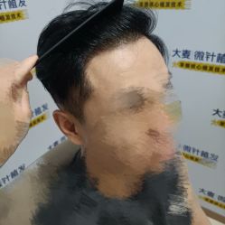 -大麦微针植发丨全国连锁