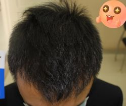 -大麦微针植发丨全国连锁