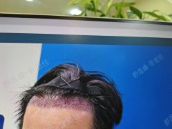 -碧莲盛·不剃发植发