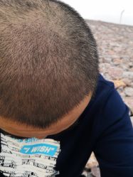 -大麦微针植发丨全国连锁