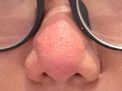 体验前-KS科逆美肤祛痘