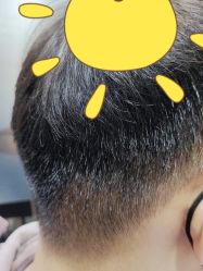 体验后-熙朵美学植发·连锁品牌