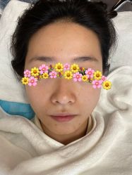体验前-肌密·水光·祛痘·黄金微针