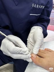 -德哥灰指甲脚气甲沟炎跖疣护理