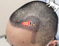 -大麦微针植发全国连锁