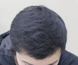 -大麦微针植发全国连锁