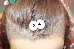 -大麦微针植发全国连锁