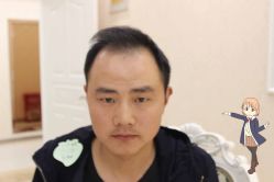 -大麦微针植发丨全国连锁