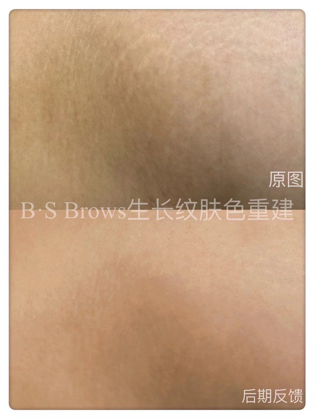 侧腰生长纹肤色覆盖