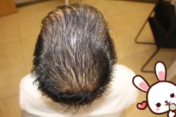 -大麦微针植发丨全国连锁