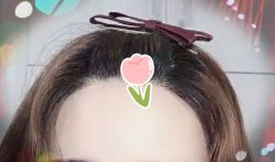 -大麦微针植发全国连锁