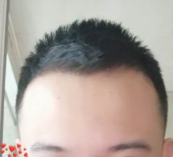 -大麦微针植发丨全国连锁