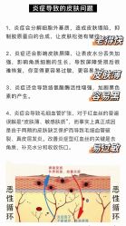 -美丽人生祛斑扁平疣汗管瘤中心
