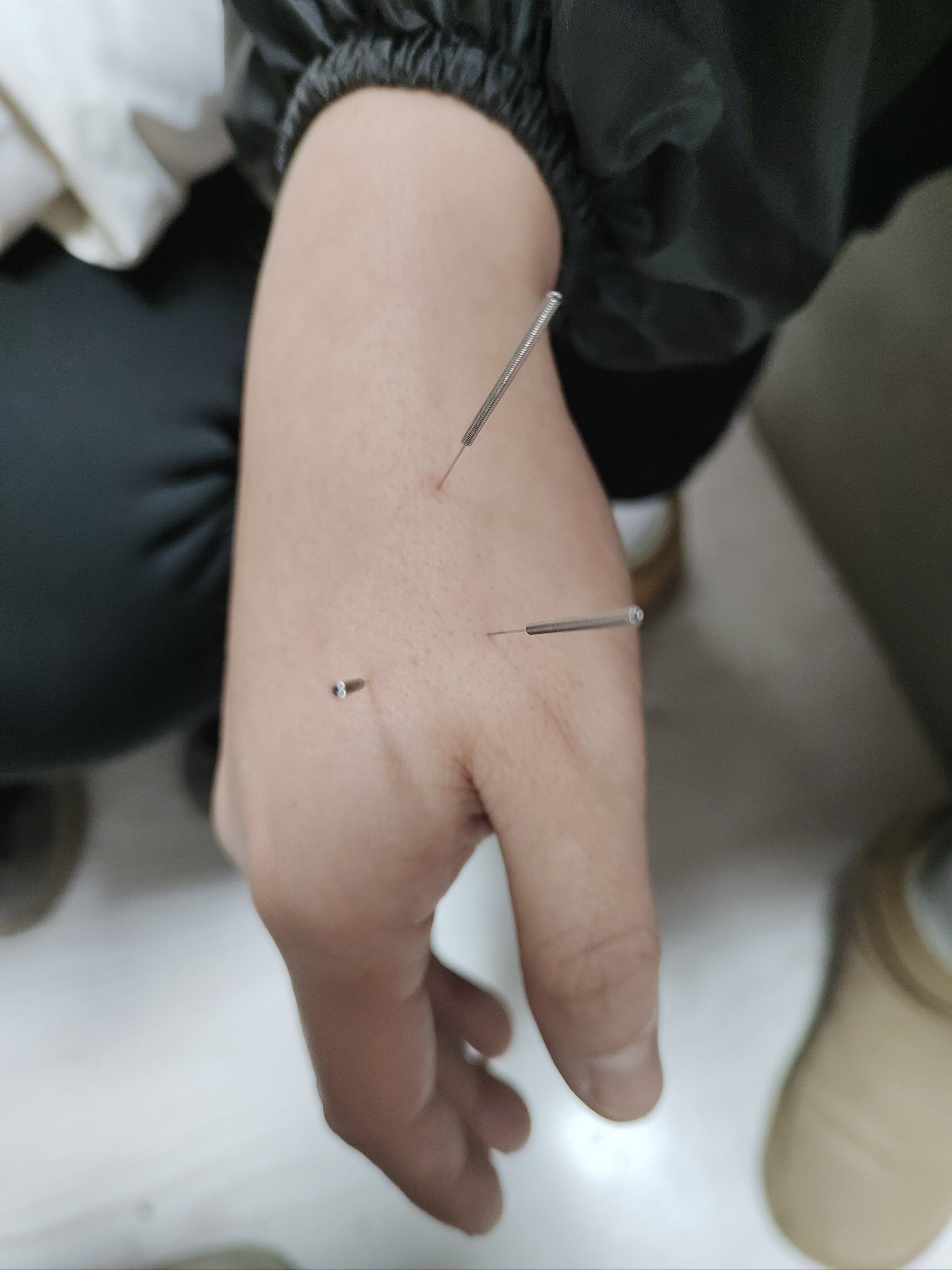 中医针灸,气血三针.