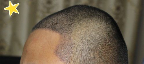 -大麦微针植发丨全国连锁