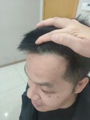 点击看大图 -大麦微针植发丨全国连锁