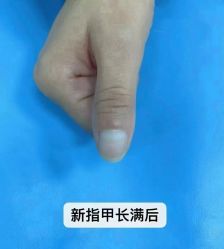 -德哥灰指甲脚气甲沟炎跖疣护理
