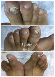 -德哥灰指甲脚气甲沟炎跖疣护理