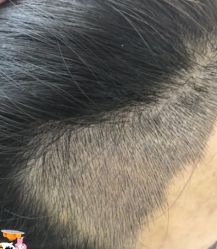 -大麦微针植发丨全国连锁