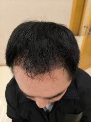 -大麦微针植发丨全国连锁