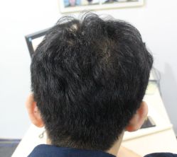 体验后-大麦微针植发全国连锁