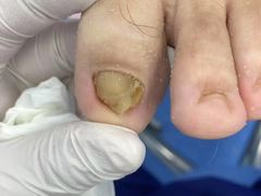 -Andrew指甲专科灰指甲·甲沟炎矫正·3D步态矫形鞋垫定制(上海法华镇路旗舰店)