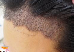 -大麦微针植发丨全国连锁