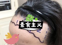 -大麦微针植发全国连锁