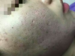 点击看大图 效果很明显!!-痘院长·祛痘·皮肤管理
